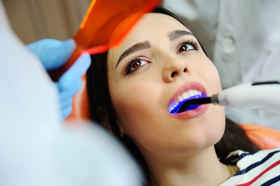 tooth colored fillings coral gables fl