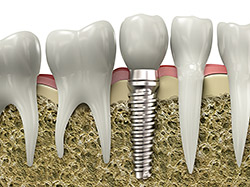 dental implants coral gables