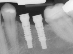 X-ray of an tooth implant in position